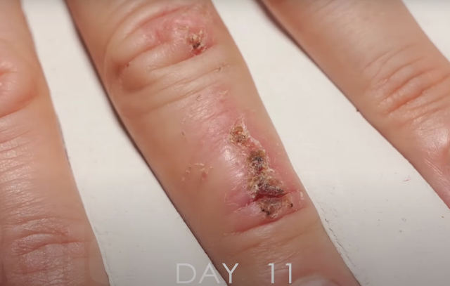 Timelapse Of Finger Damage Healing Over 33 Days
