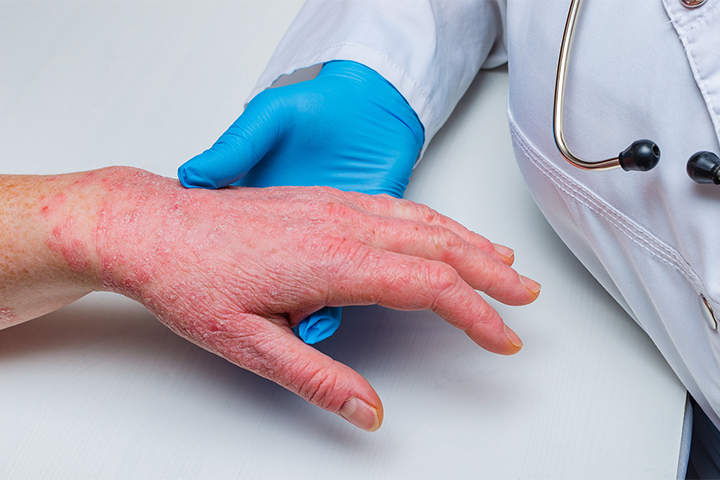 As soon as-Each day Abrocitinib Succeeds for Atopic Dermatitis
