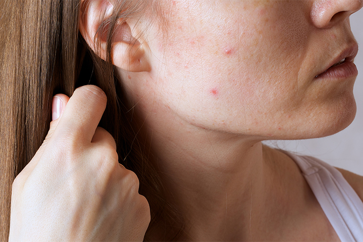 With Grownup Acne, You Are What You Eat