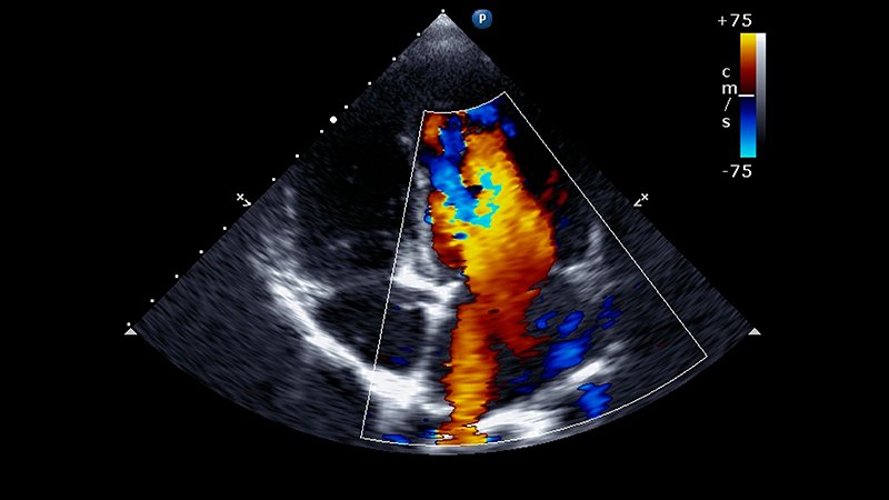 Streamlined Aortic Stenosis Care Eventually of COVID-19