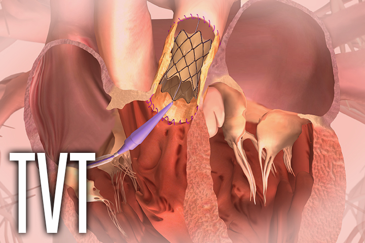 No Clarity on Scientific Impression of Post-TAVR Leaflet Thrombosis