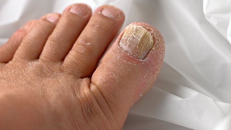 Pulse vs Continuous Therapy for Toenail Onychomycosis