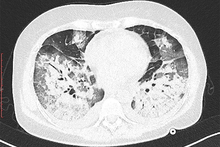 CT Needless for COVID-19 Diagnosis, Seek for Affirms