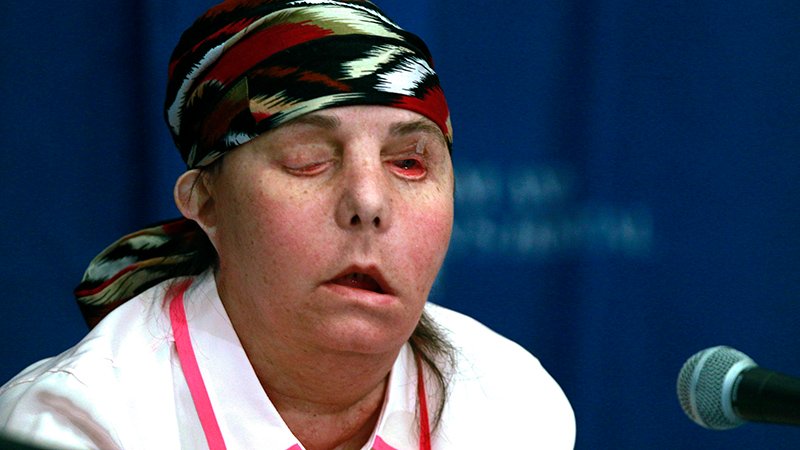 Girl Is First in US to Earn 2nd Face Transplant