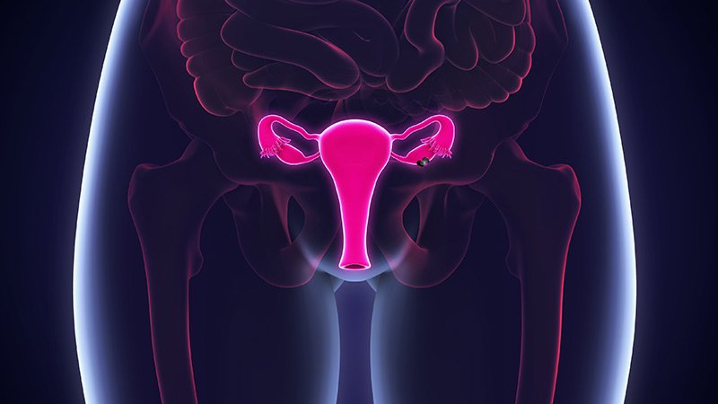 Gene Signature Could well Give a enhance to Prognostication in Ovarian Most cancers