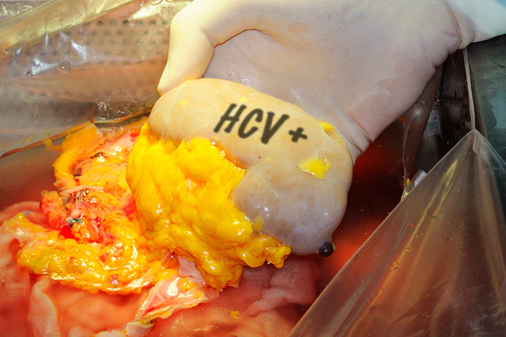 Pre-Op DAAs Enable for HCV-Infected Kidney Transplants in Tiny Trial