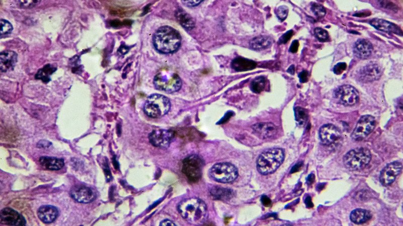 Hepatocellular Carcinoma Reveals Possibility Element Shift