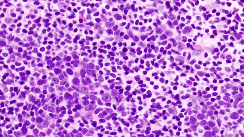 7 Things to Know About Unique Lymphoma Drug Tafasitamab