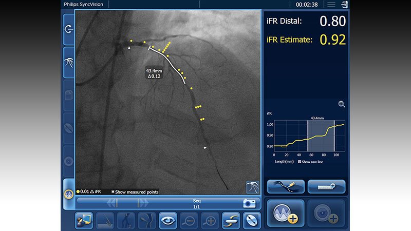 DEFINE PCI: Tightly iFR-Optimized PCI Would possibly well Carve relief Cardiac Match Threat