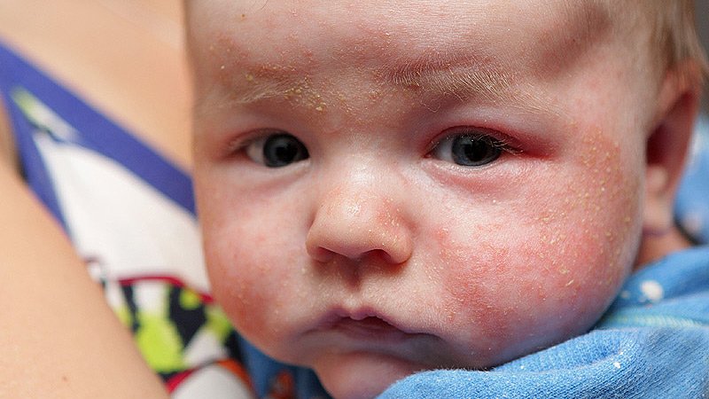 Meals Allergy Attempting out for Eczema in Formative years Varies By Uniqueness