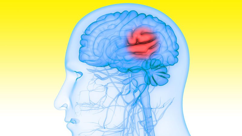 Disabling Stroke Diminished With Ticagrelor After Minor Stroke, TIA