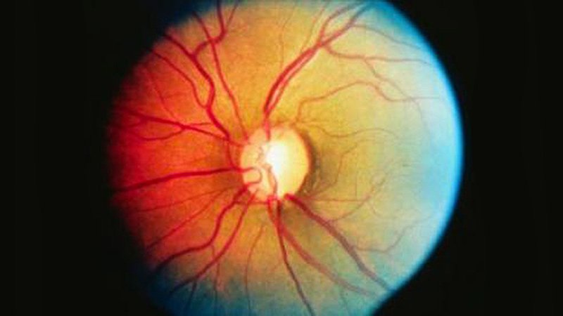 EMA Panel Backs Roclanda Eyedrops, Unique Possibility for Glaucoma