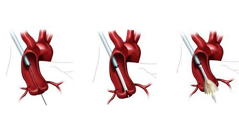 TAVR Surpasses SAVR in US, Outcomes Continue to Enhance