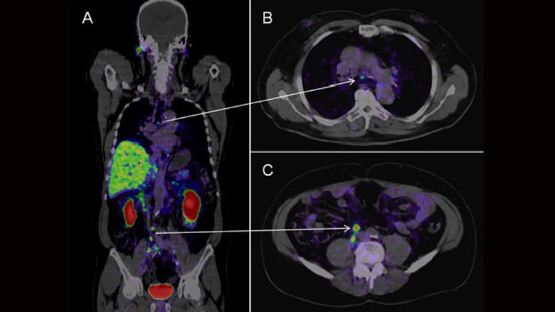 PSMA PET: A ‘Valid Game Changer’ in Excessive-Threat Prostate Most cancers