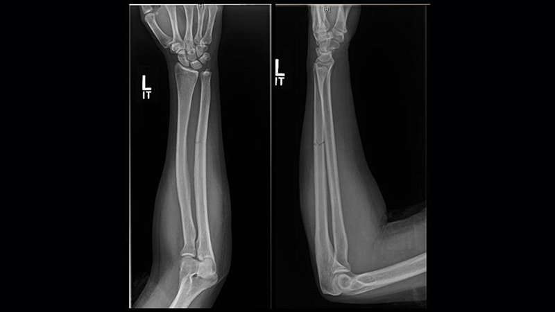 Nondisplaced Ulna Smash Might presumably Imply Intimate-Partner Violence