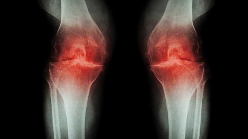 Precise Acupuncture Beat Sham for Osteoarthritis Knee Distress