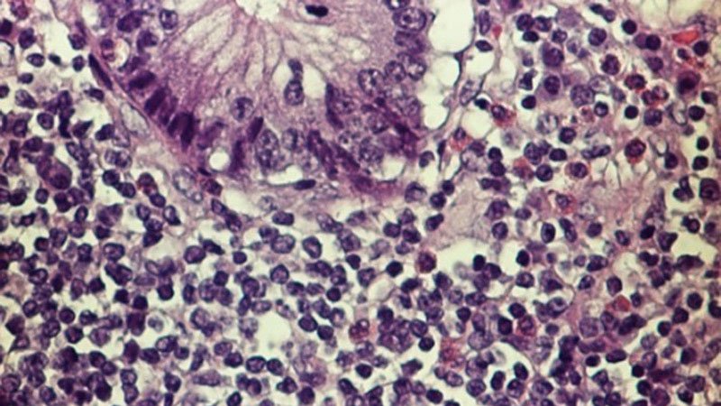 First CAR T-cell Tx for Mantle Cell Lymphoma Fills Unmet Need