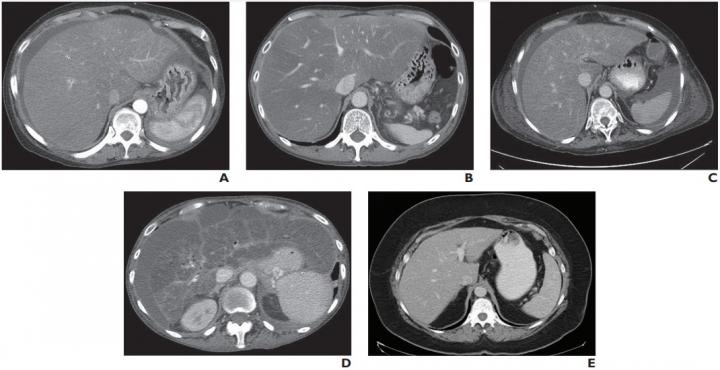 CT identifies sufferers with excessive-anguish nonalcoholic fatty liver illness (NAFLD)