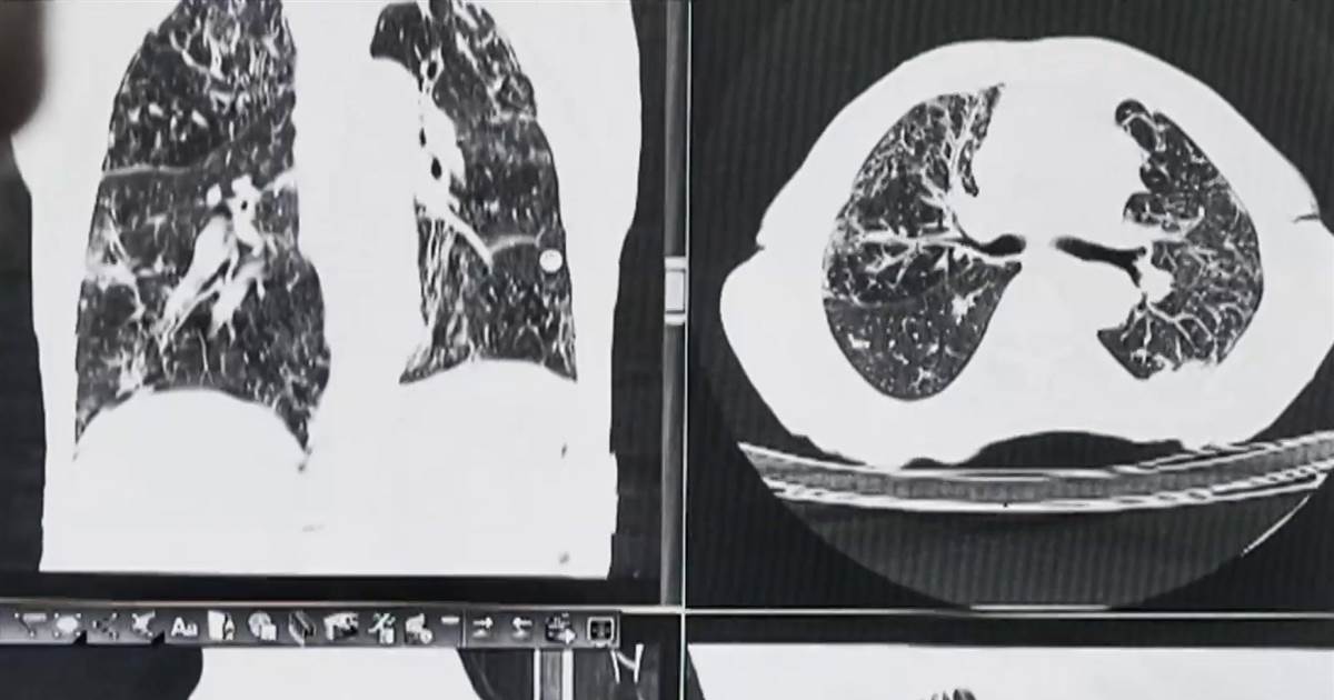 Fresh guidelines decrease lung cancer screening age for high risk smokers