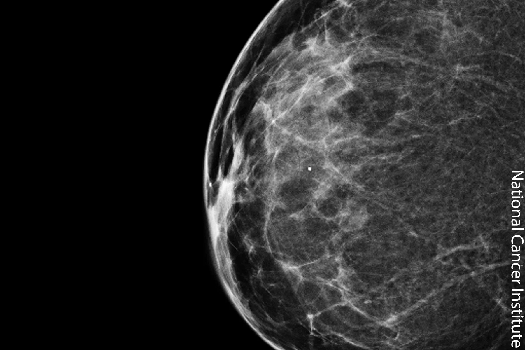 COVID: Mammogram Charges Rebound, Concerns Stay