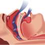 Treating sleep apnea could perchance maybe well decrease dementia concern