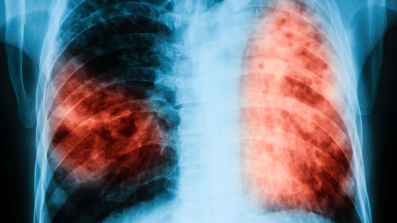 TB Routine Cuts Treatment Time by a Third