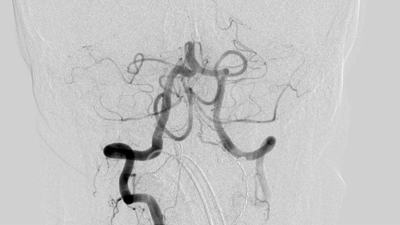 The same Final consequence With EVT and Medical Tx in Basilar Artery Stroke