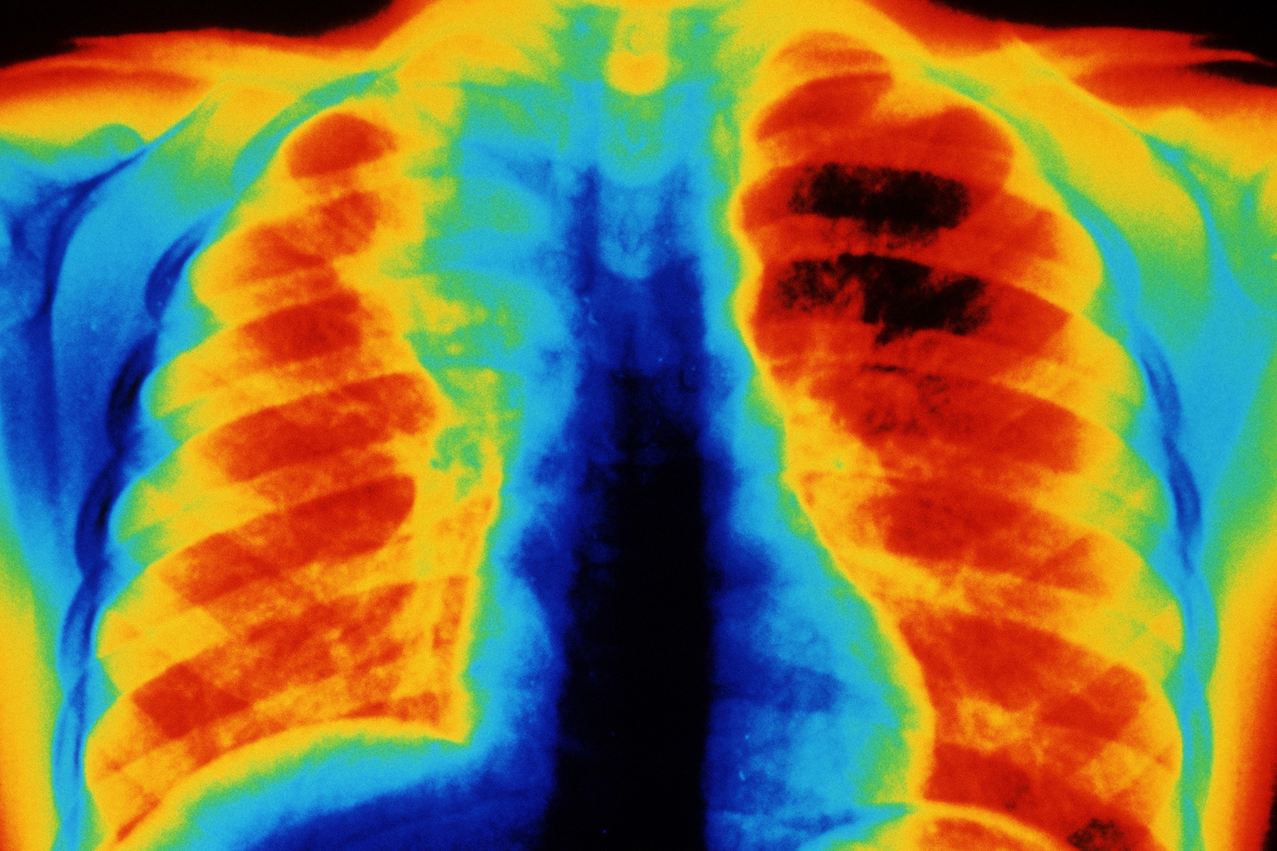 Americans’ Lung Health: The Heart-broken Endure Most