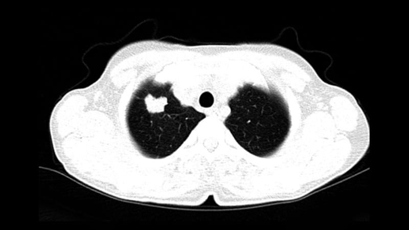 LDCT Lung Most cancers Screening Can also ID Aortic Stenosis Threat