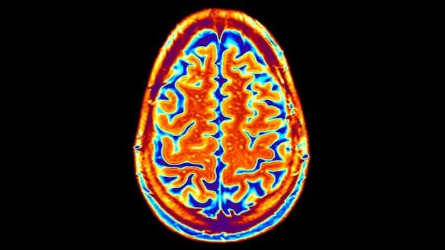 Cortical Ground Changes Tied to Stream Concerns in Schizophrenia