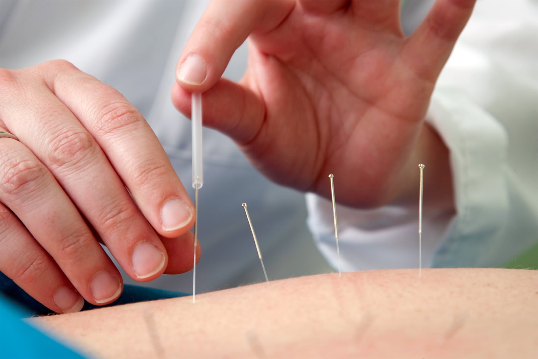Acupuncture On Level for COVID stress Relief