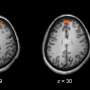 Biomarker also can abet prognosis schizophrenia at an early age