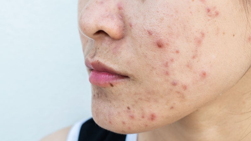 Search for Highlights Accomplish of Acne in Grownup Females on Quality of Existence