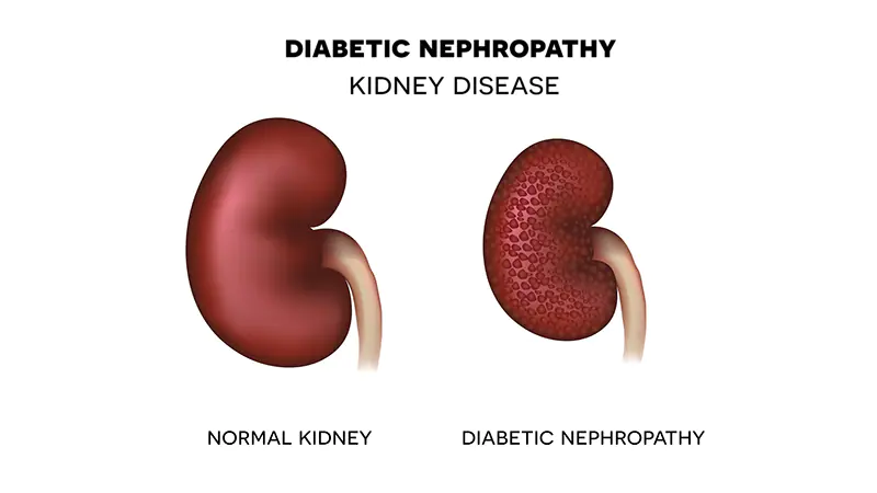 Family Clinical doctors Omit Assessments for Kidney Illness in Form 2 Diabetes