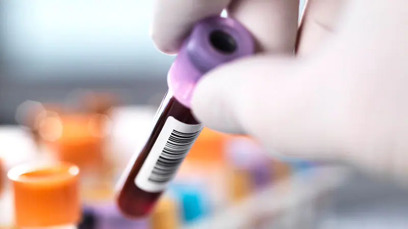 Blood Biomarkers for Alzheimer’s ‘Promising’ nonetheless Nuanced