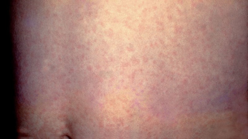 25% of Sufferers With Most cancers Lack Immunity In opposition to Measles
