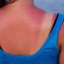 Health care visits for sunburn are rare