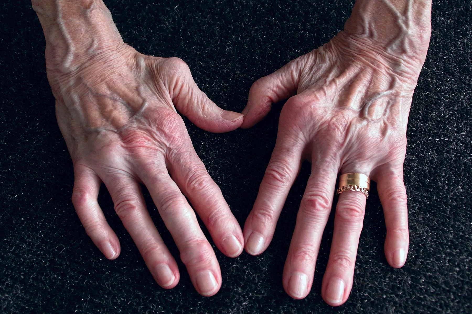 Secondhand Smoke Can even merely Raise Youngsters’ Rheumatoid Arthritis Risk