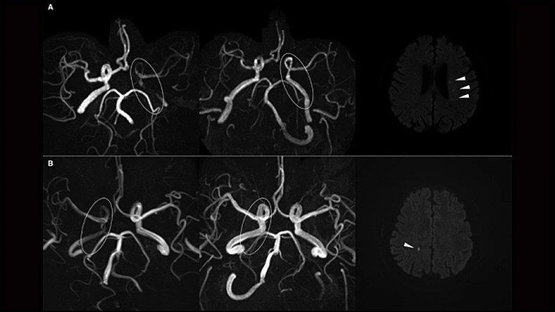 Acute C-ICA Stenting Tied to Abet in Tandem Occlusion Strokes