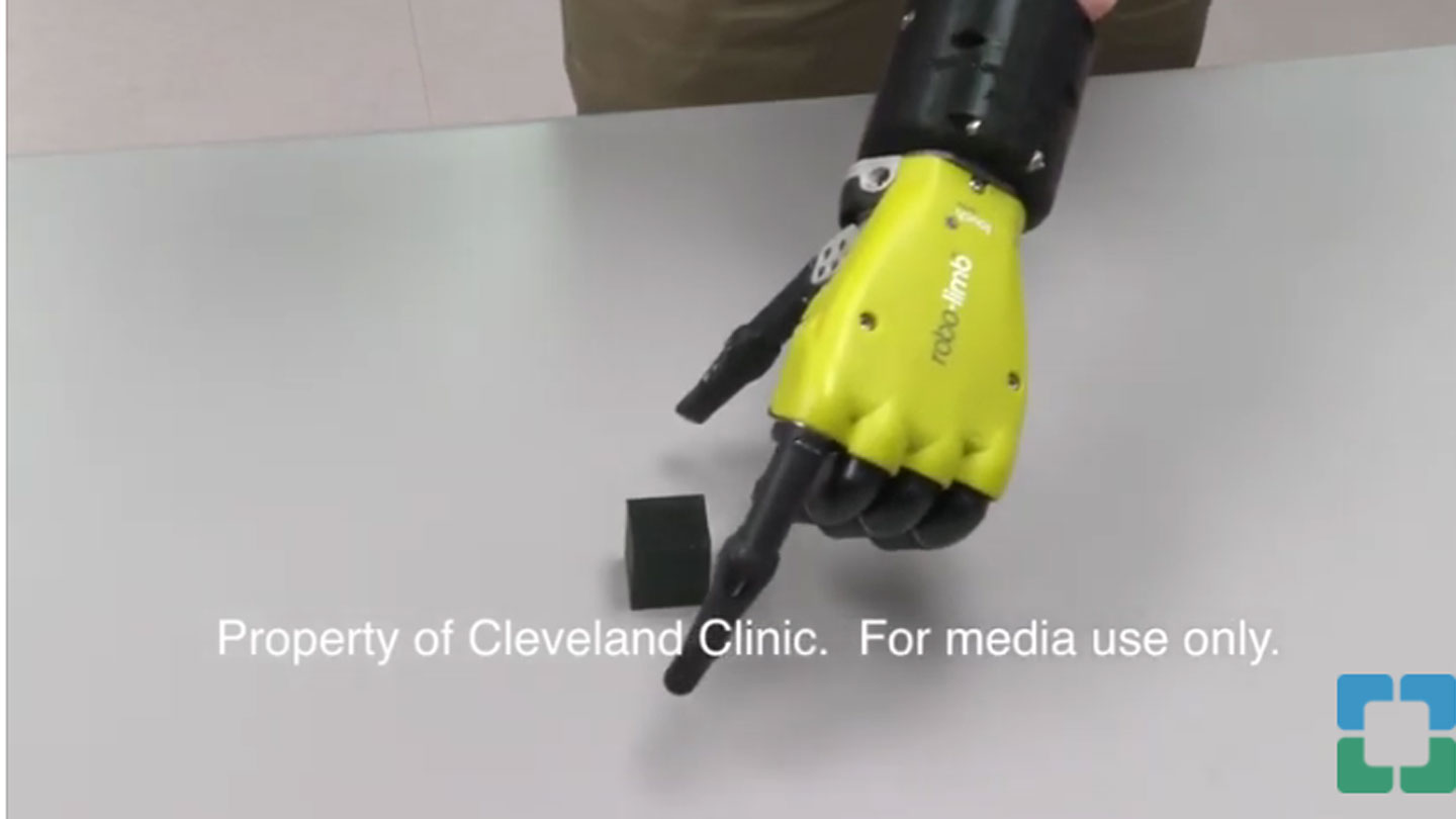 Bionic arm communicates with the brain of the wearer