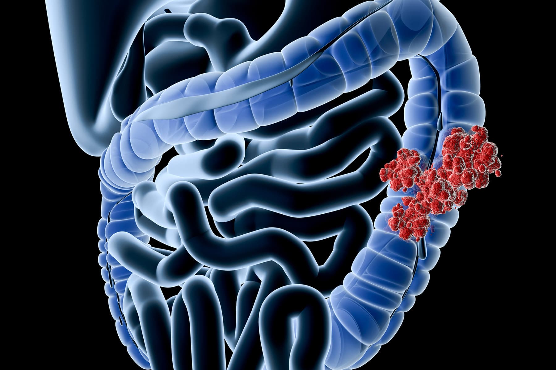 Colon Cancer, Typically Avoidable, Hits Black Males, the Young More