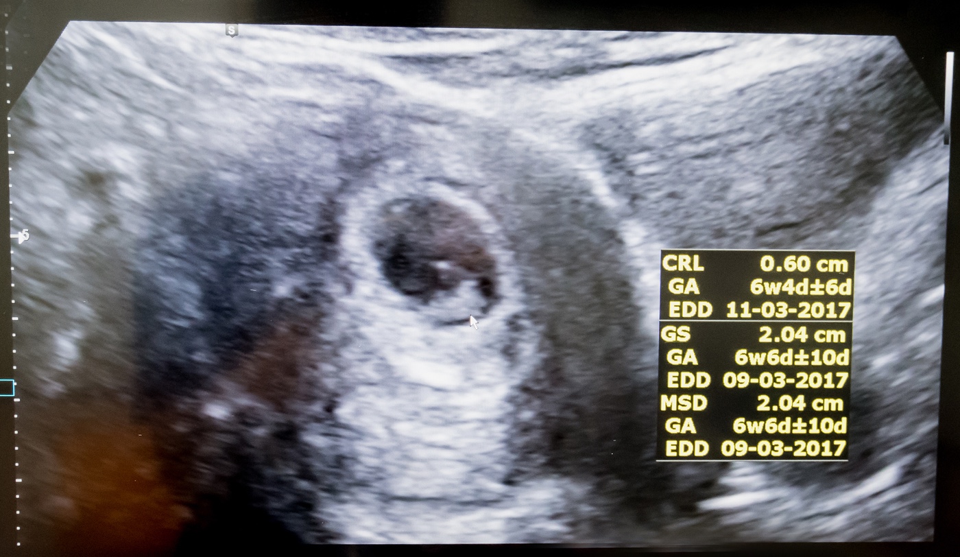 Is a ‘fetal heartbeat’ if truth be told a heartbeat at 6 weeks?