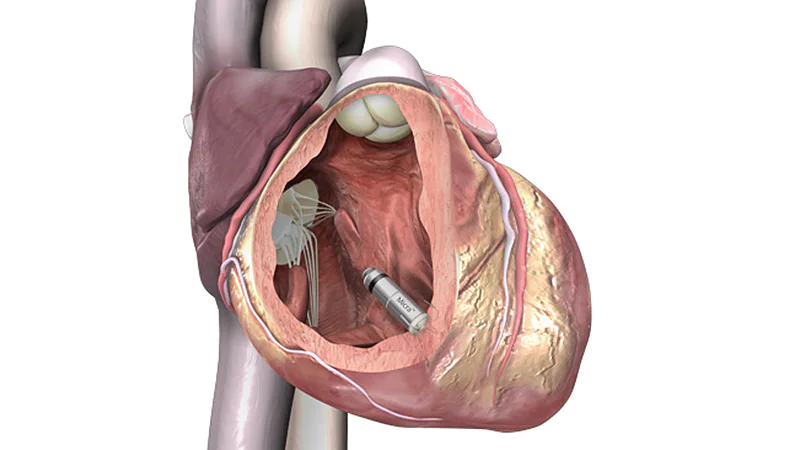 Micra Leadless Pacemaker Holds Up at 2 Years in Exact-World Exhaust