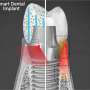 Researchers constructing neat dental implants that face up to bacterial boost, generate their occupy electricity
