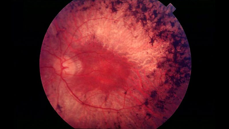 Gene Remedy Overview Accelerates for Retinal Illnesses