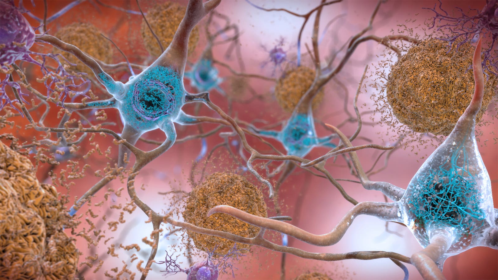 Amyloid Tipping Level Helps Predict Alzheimer’s Dementia Onset