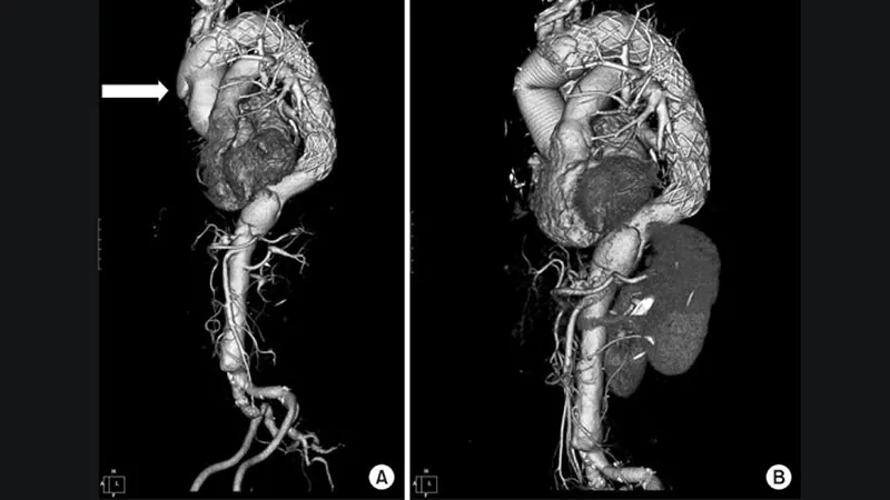 Low Rate of Be aware-up Imaging After Aortic Dissection Restore
